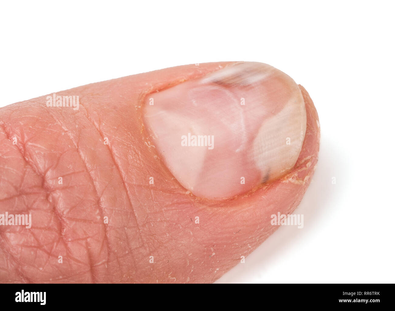 Un doigt de la main avec un champignon sur les ongles isolé sur fond blanc Banque D'Images