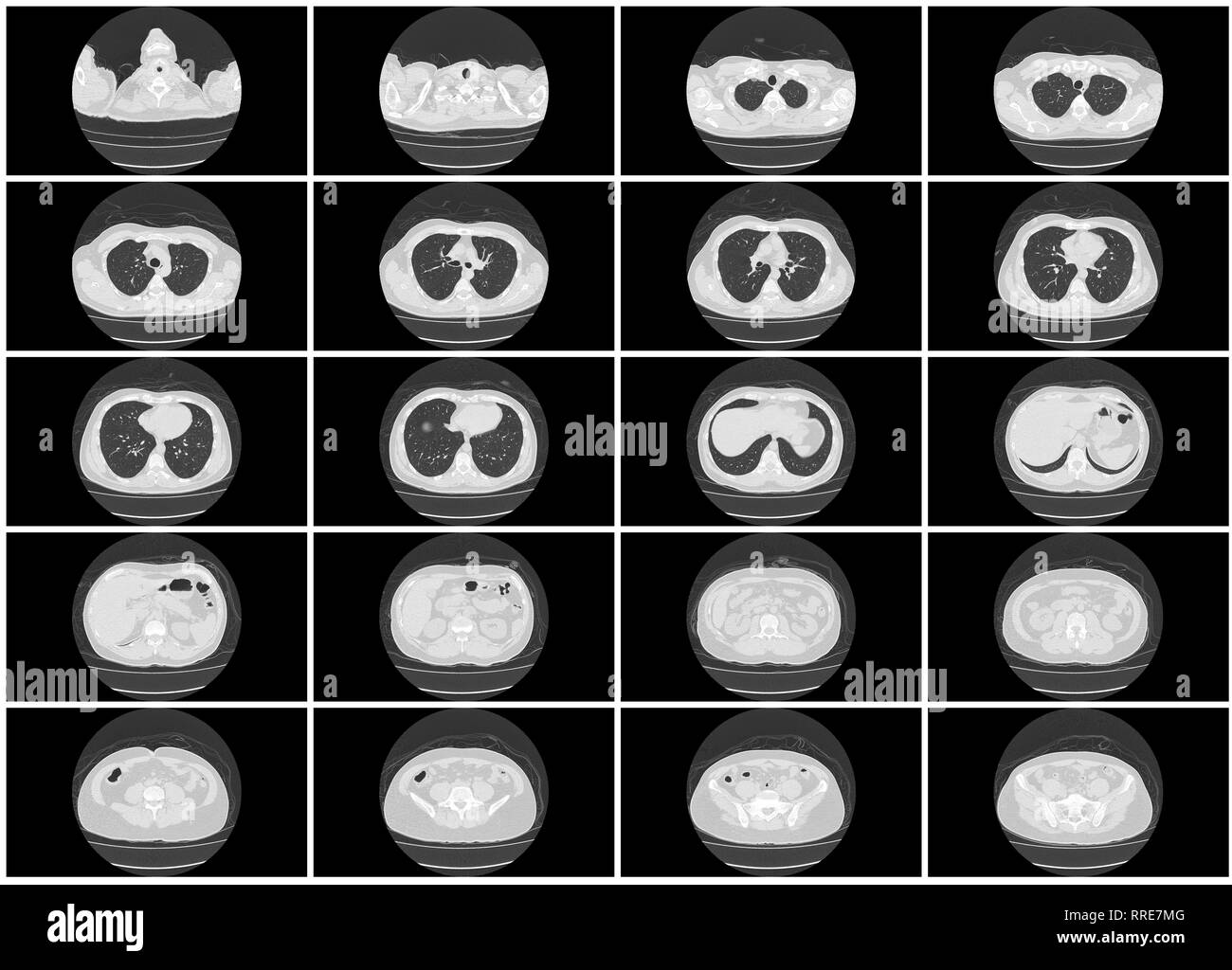 Ensemble de l'étape scanner pulmonaire haut du corps haut vue axiale Banque D'Images