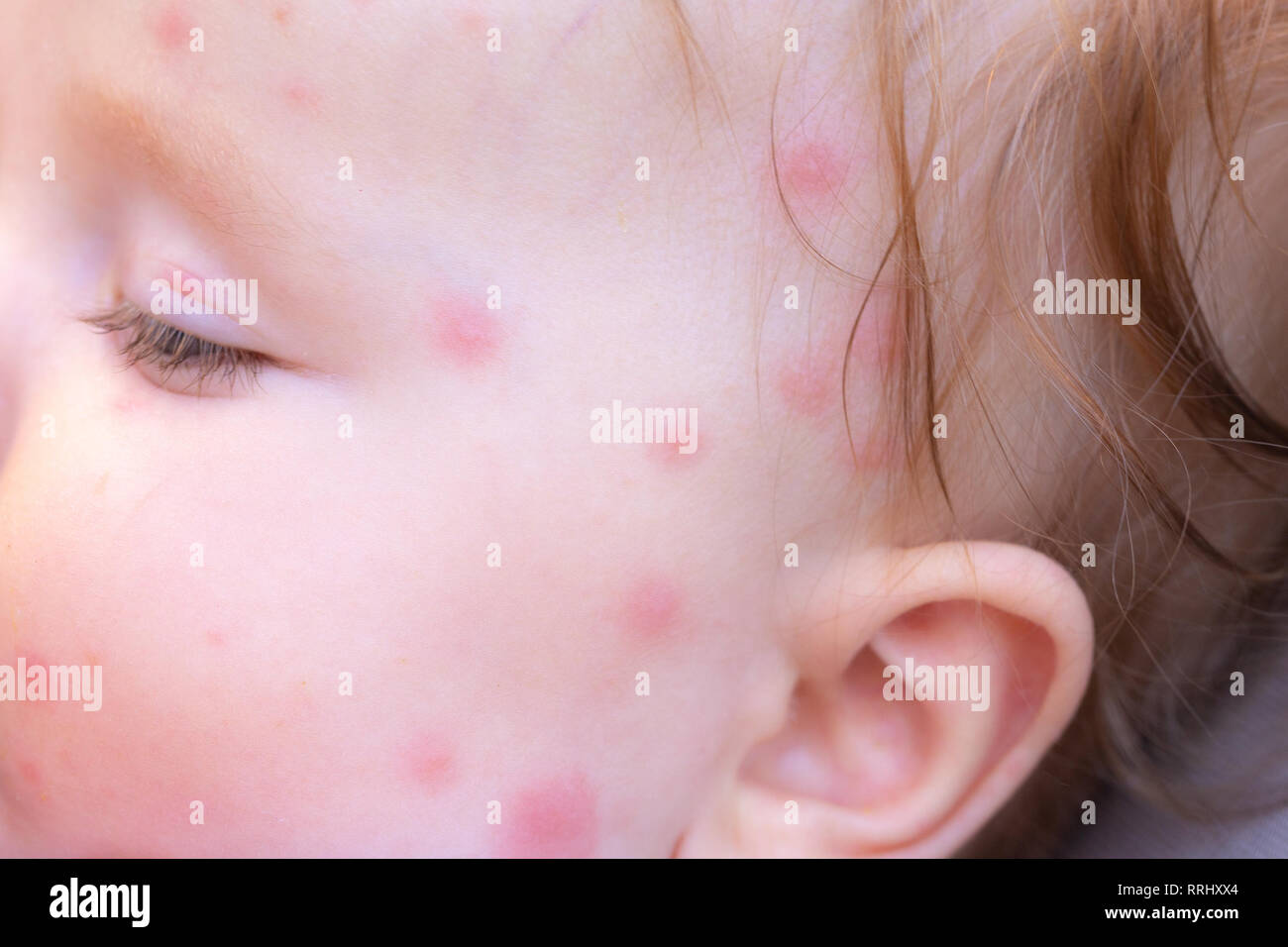 Les Piqures De Moustiques Dans Le Visage D Un Petit Bebe En Ete Photo Stock Alamy