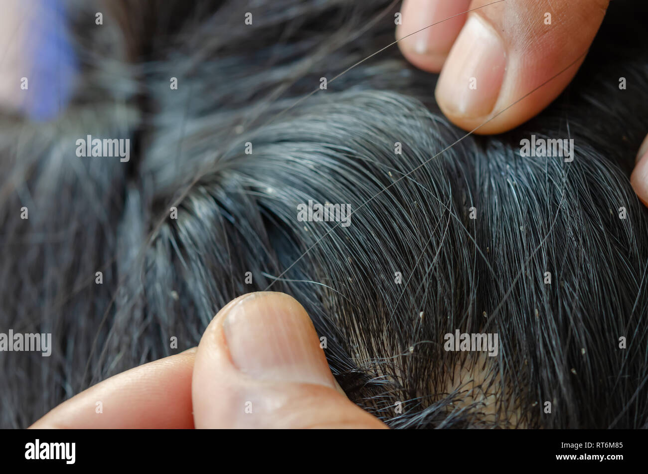 Oeufs De Poux Sur La Tete De Cheveux Causes De Demangeaisons Photo Stock Alamy Oeufs De Poux Sur La Tete De Cheveux Causes De Demangeaisons Photo Stock Alamy