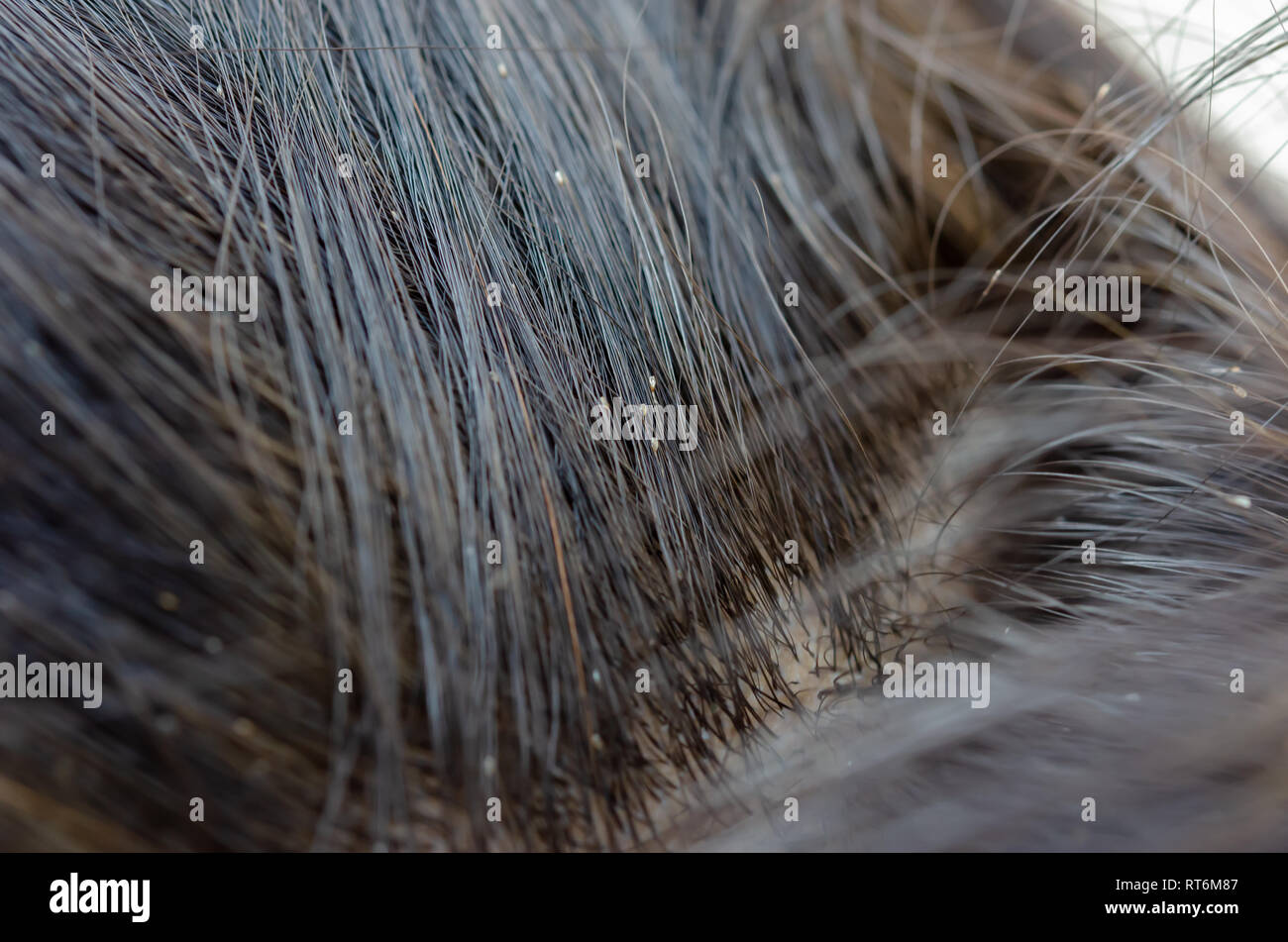 Oeufs De Poux Sur La Tete De Cheveux Causes De Demangeaisons Photo Stock Alamy Oeufs De Poux Sur La Tete De Cheveux Causes De Demangeaisons Photo Stock Alamy