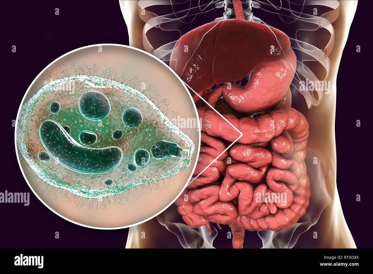 Balantidiasis, conceptual image. Illustration de l'ordinateur vue rapprochée de protozoaire cilié Balantidium coli, un parasite intestinal le causati Banque D'Images