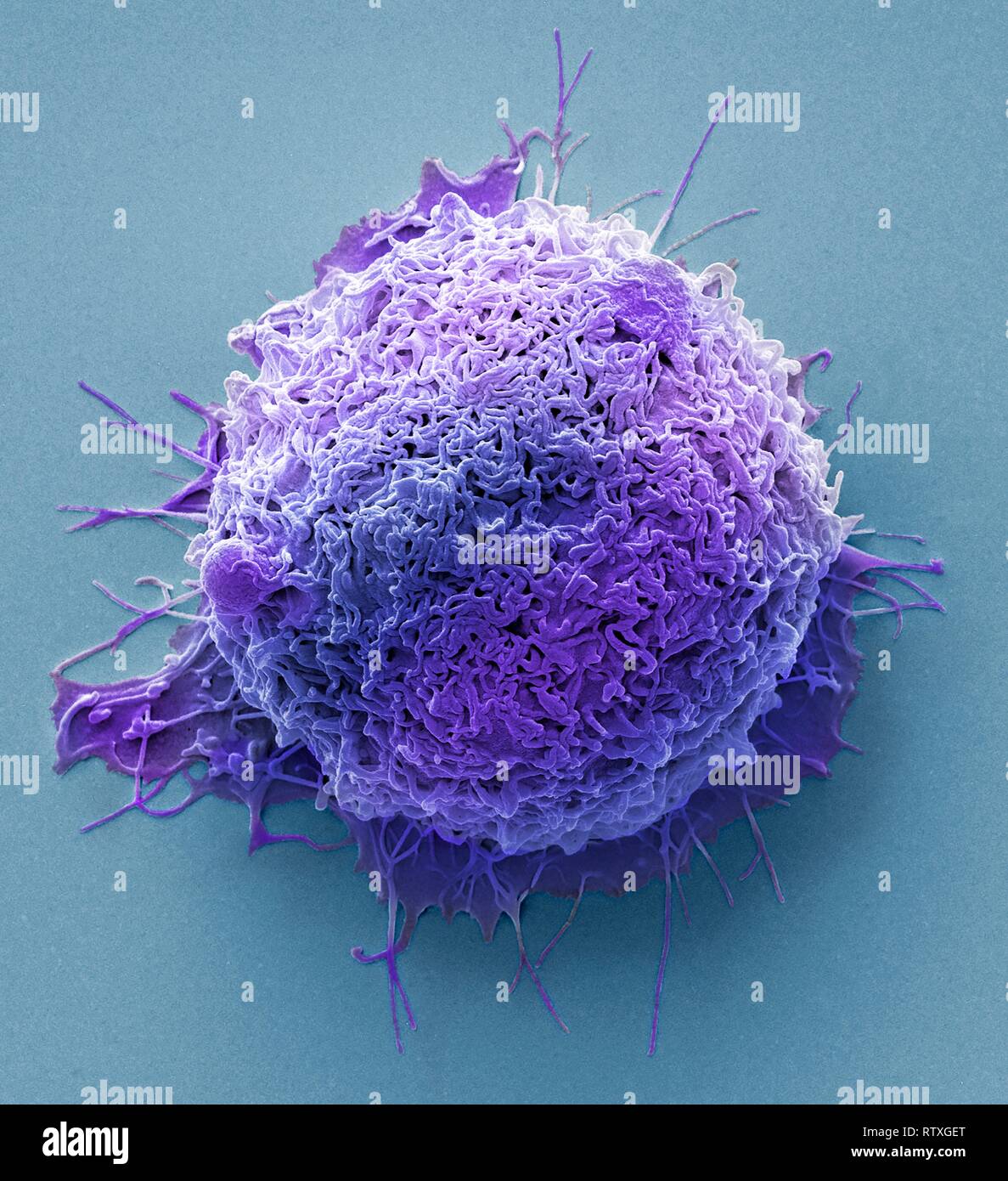 Les cellules du cancer colorectal. Couleur de l'analyse des électrons Microphotographie (SEM) d'une cellule de cancer du côlon (gros intestin). Le cancer du côlon est al Banque D'Images