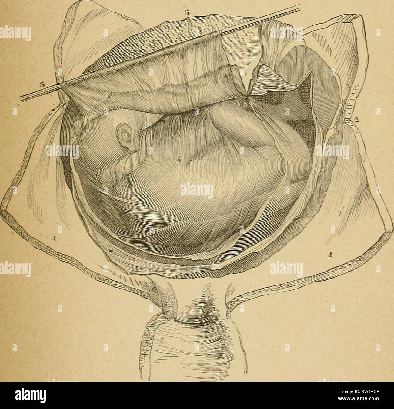 Eléments d'anatomie et de physiologie ElÃ©ments d'anatomie et de physiologie gÃ©nitale et obstÃ©tricale ; prÃ©cÃ©des de la description sommaire du corps humain a l'usage des sages-femmes elmentsdanatom00pozz Année : 1894 liquide amniotique Liquide amniotique â ORIGINE 251. Â QuantitÃ©. Â La Composition. "Le liquide amniotique qui apparaÃ®t, peu aprÃ¨s le dÃ©but de la grossesse, est, à terme, d'une quantitÃ© Ã©quivalant Ã environ 1/2 litre. Il est clair, lÃ©gÃ¨turation jaunÃ¢tre ou blanchÃ¢tre ; agitÃ© au contact de l'eau, il mousse. Contains 11 principale- ment du chlorure de sodium, du lactate de so Banque D'Images