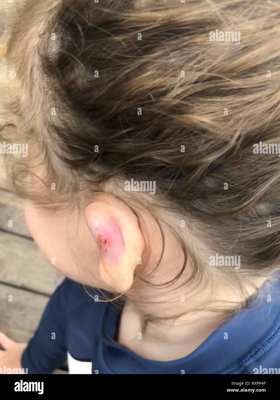 Une vue en gros plan d'une petite oreille filles qui a un été blessé, il y  a coupure et la zone endommagée est très broosed Photo Stock - Alamy