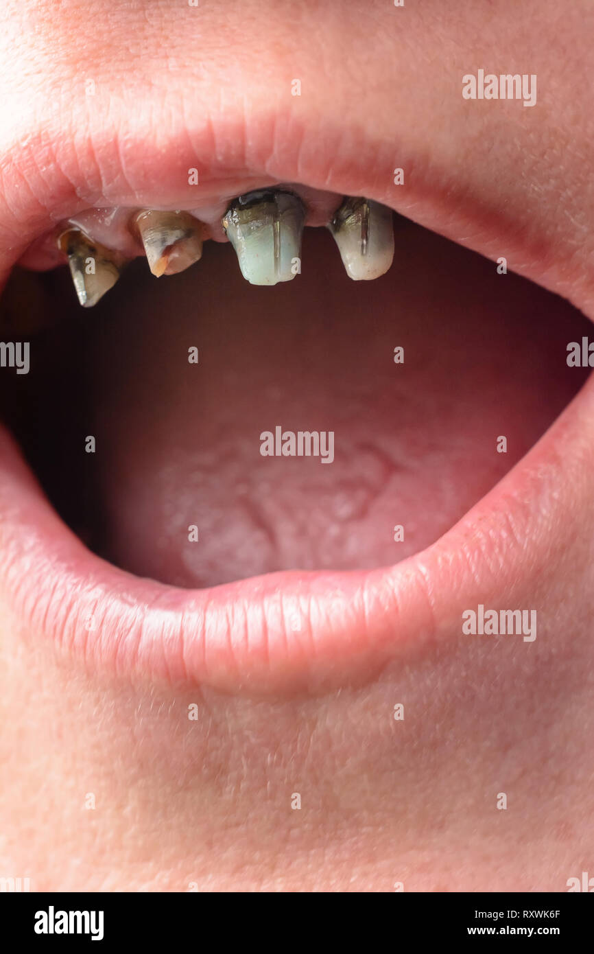 La femme ouvrit la bouche toute grande, et lui a montré les dents gâtées et crooked close up 2019 Banque D'Images