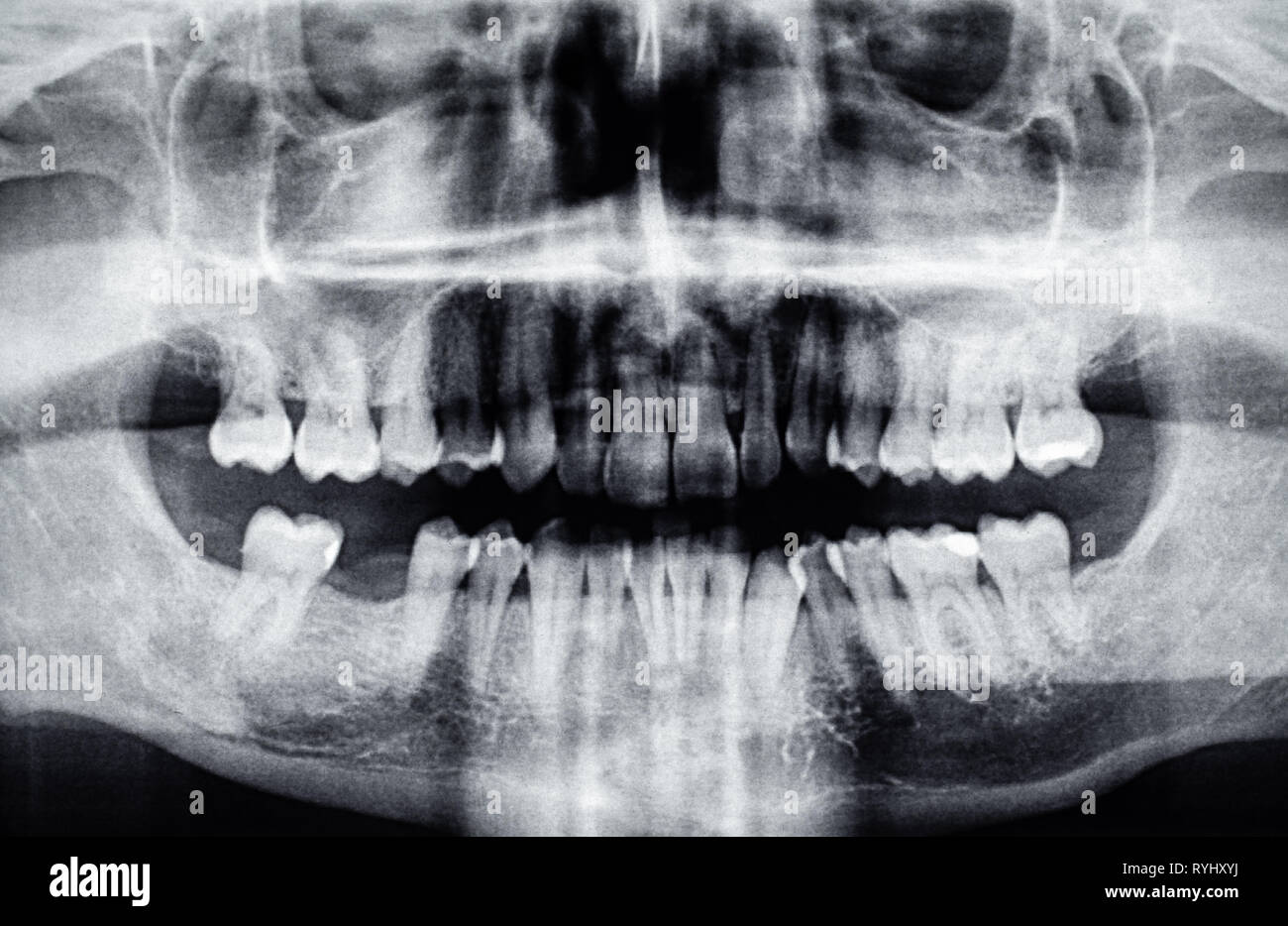 La radiographie dentaire panoramique avec un trou de la dent retour Banque D'Images