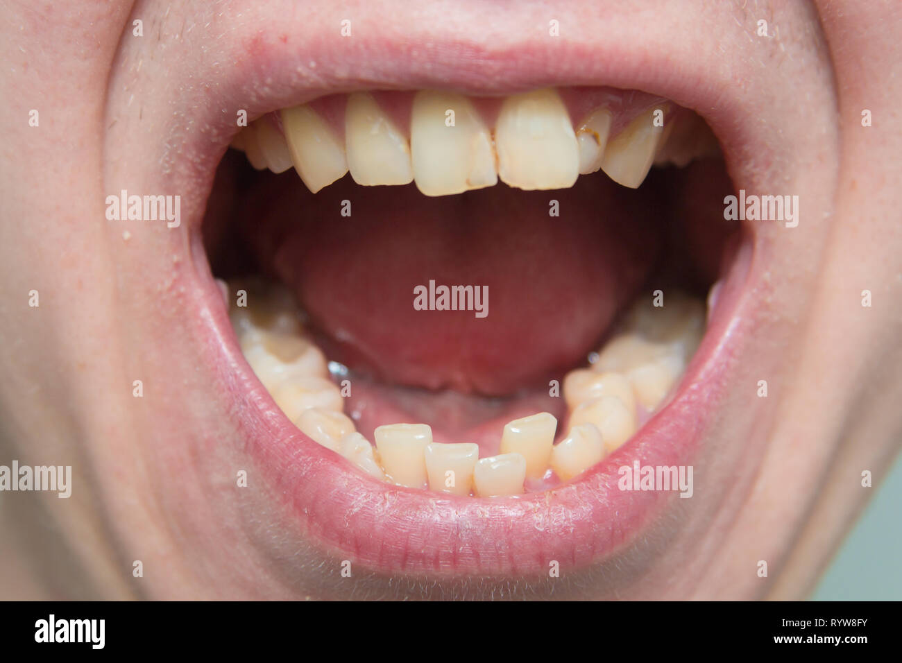 Européenne homme bouche ouverte, dents jaunes tordus lèvres sèches Photo  Stock - Alamy