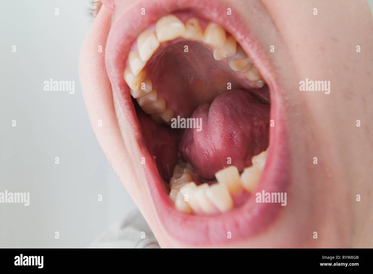 Européenne homme bouche ouverte, dents jaunes tordus lèvres sèches Banque D'Images