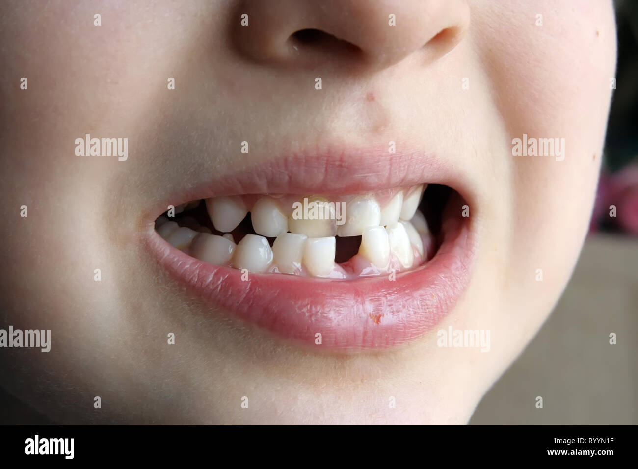 La dent manquante. Une dent manquante pour enfants. Écart entre les dents des enfants. Banque D'Images