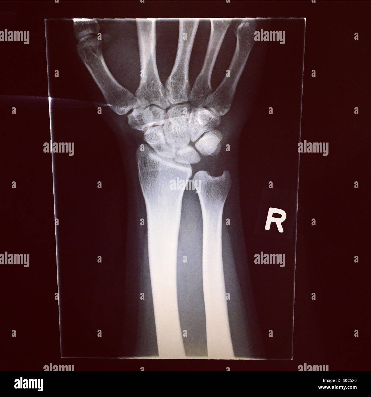 Fracture du poignet X-ray Banque D'Images