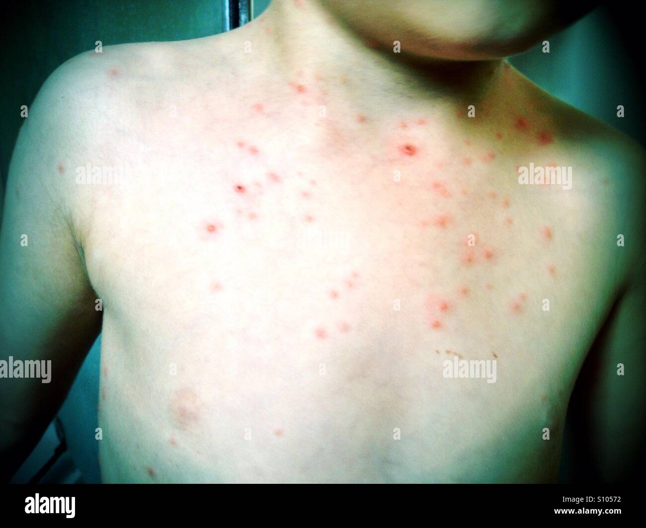 La poitrine d'un jeune enfant atteint de varicelle. Banque D'Images