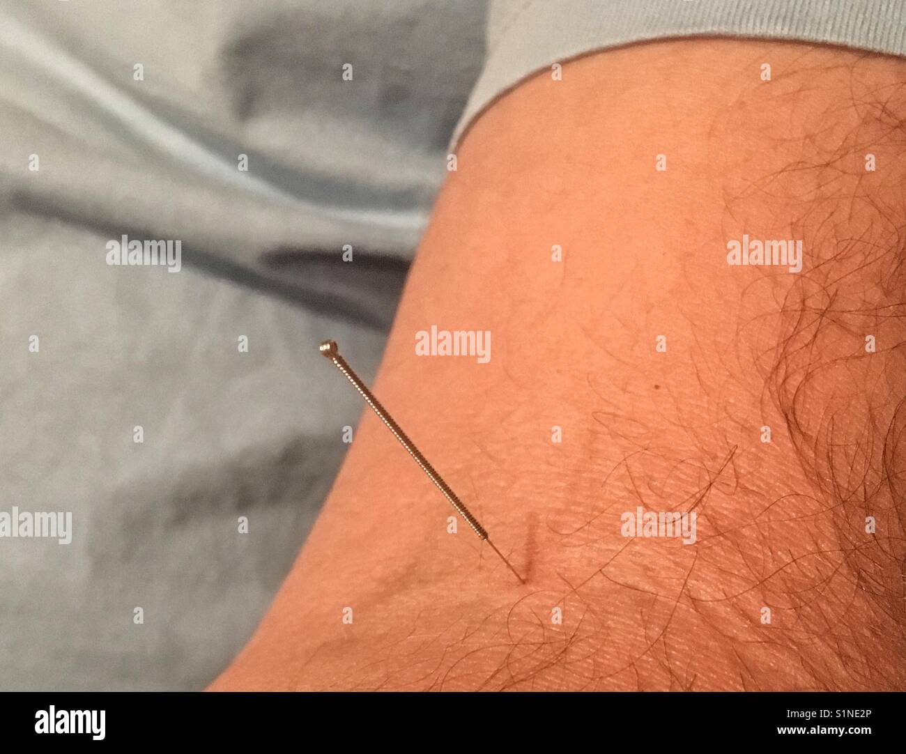 Aiguille d'acupuncture dans un bras du Mans Banque D'Images