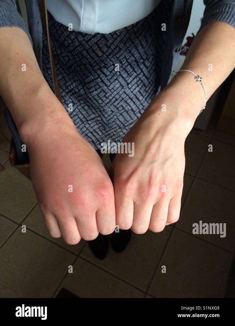 Reaction A Une Piqure De Taon Part Photo Stock Alamy