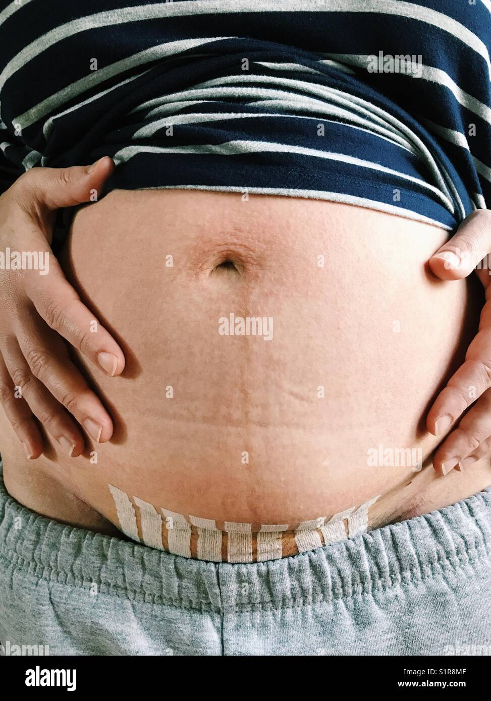 Close up of a woman's belly avec points de suture après administration d'un bébé par césarienne. Banque D'Images