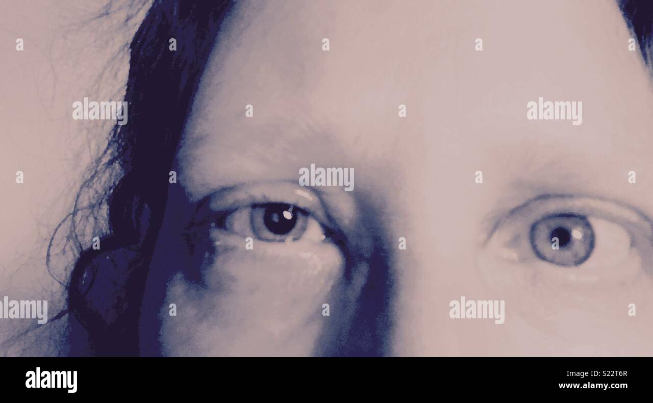 Gros plan noir et blanc de deux yeux bleus avec un œil gonflé et un œil non dilué, résultant d'une blessure due à l'abrasion cornéenne due au port de lentilles de contact. Banque D'Images