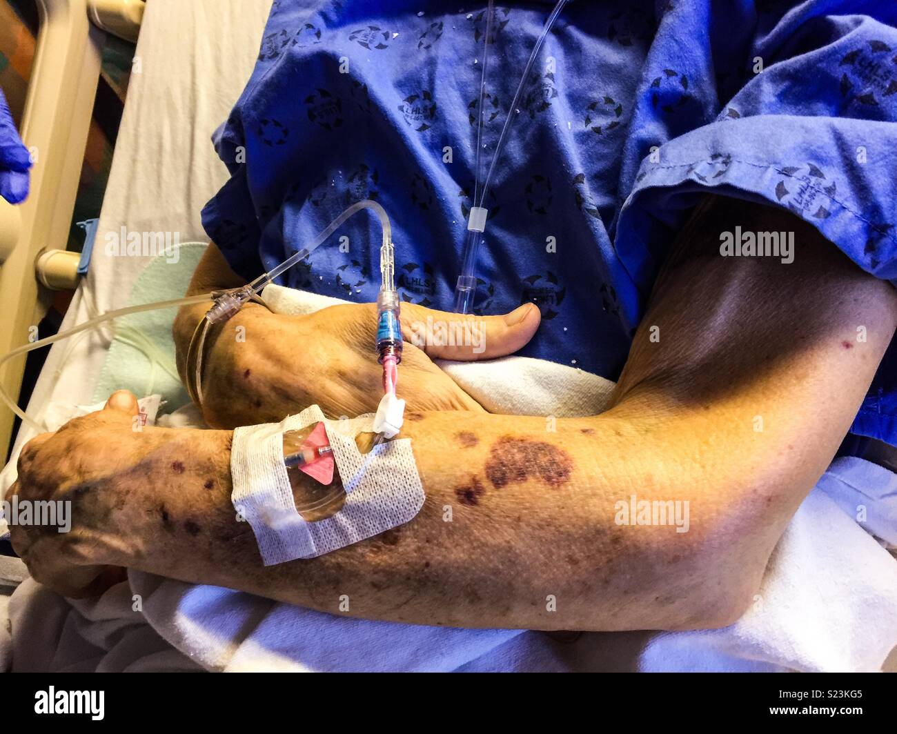 IV administrer des antibiotiques au bras d'un patient souffrant de maladie chronique dans un hôpital, Ontario, Canada. Soins de longue durée. - Image de stock capturée avec un smartphone