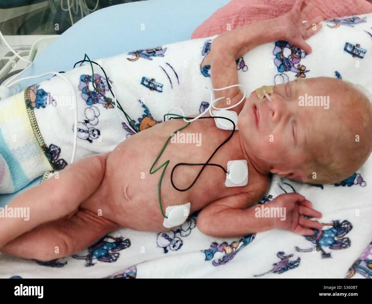 Jour 5 Un Vieux Bebe Ne Premature A 31 Semaines Pesant 1 Kg Avec Le Syndrome De Detresse Respiratoire Et D Une Jaunisse Photo Stock Alamy