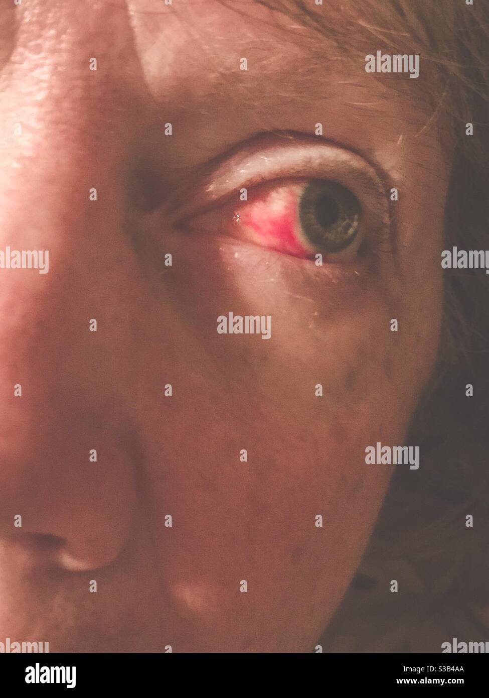 Vaisseau sanguin cassé dans l'œil de la femme d'âge moyen Banque D'Images