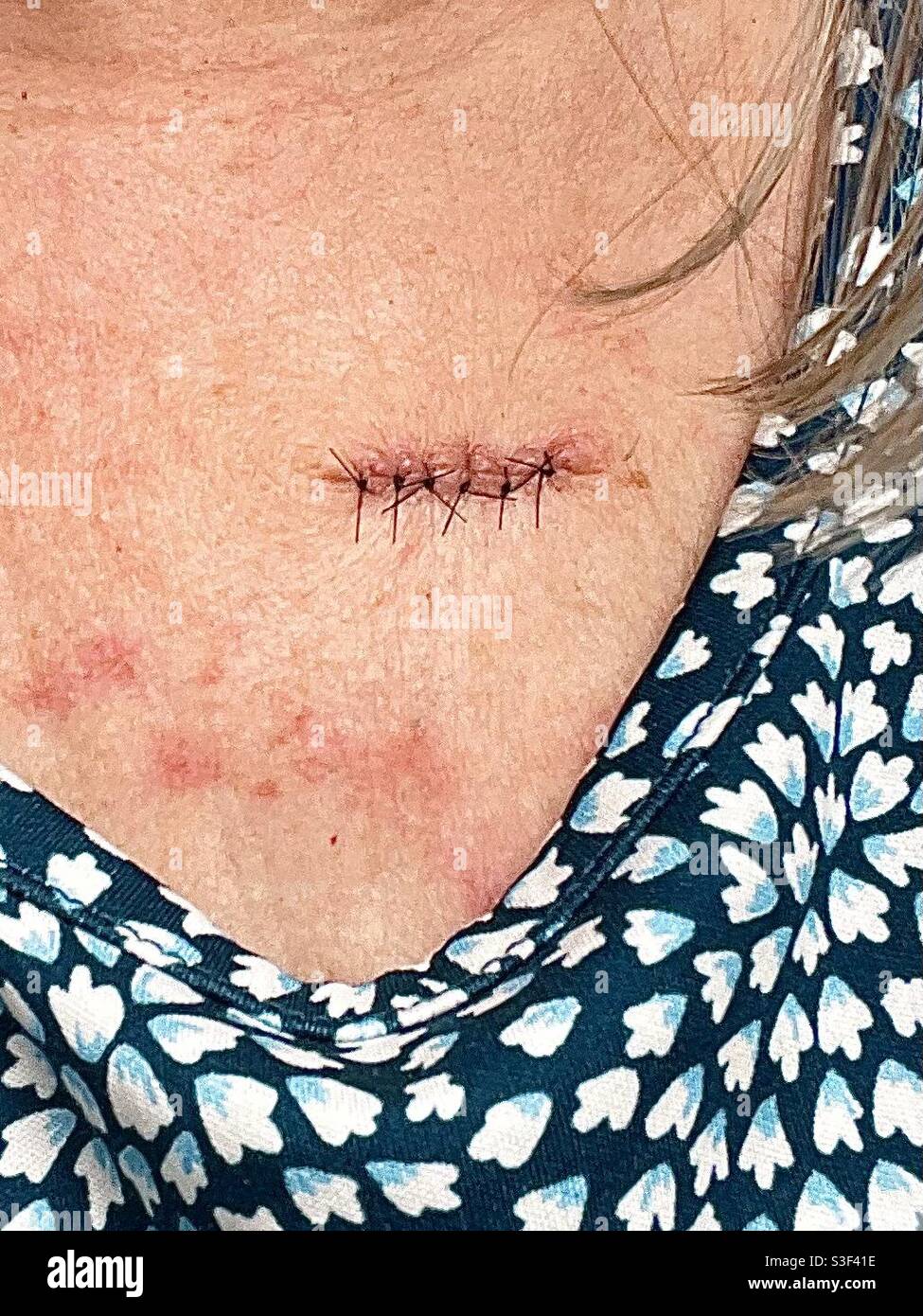 Gros plan des points de suture après une intervention médicale Banque D'Images