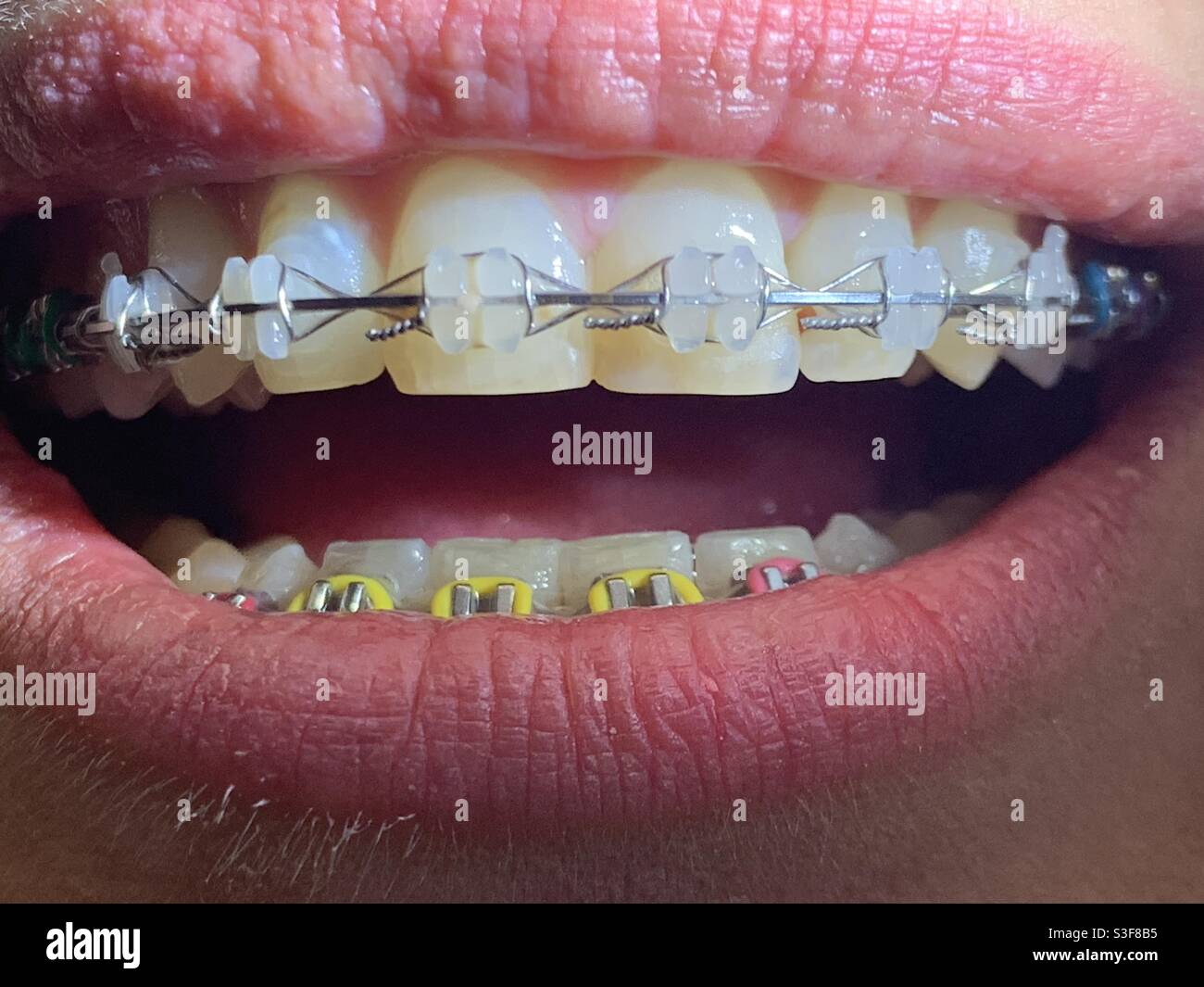Appareil dentaire céramiques Banque de photographies et d'images à haute  résolution - Alamy