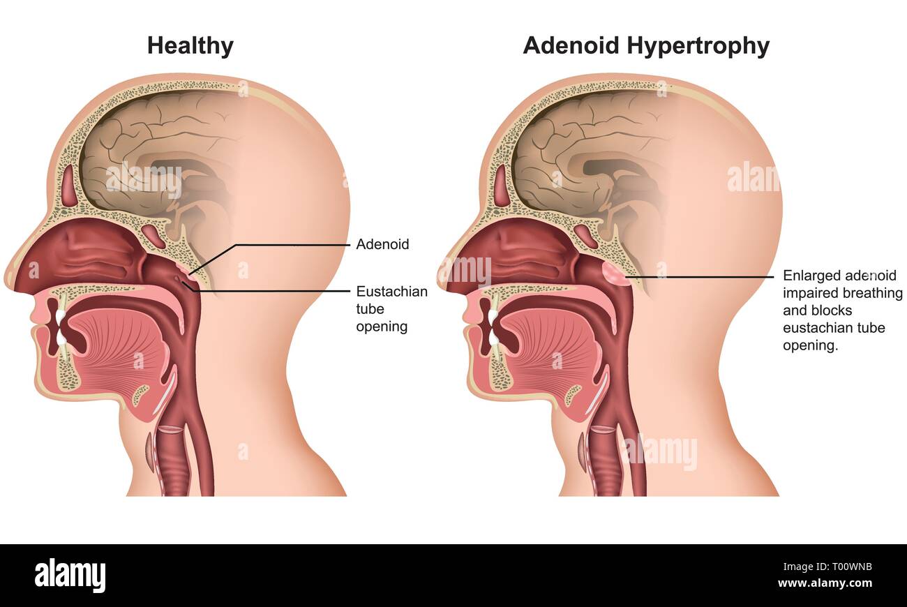 Hypertrophie adénoïde vector illustration médicale sur fond blanc Illustration de Vecteur