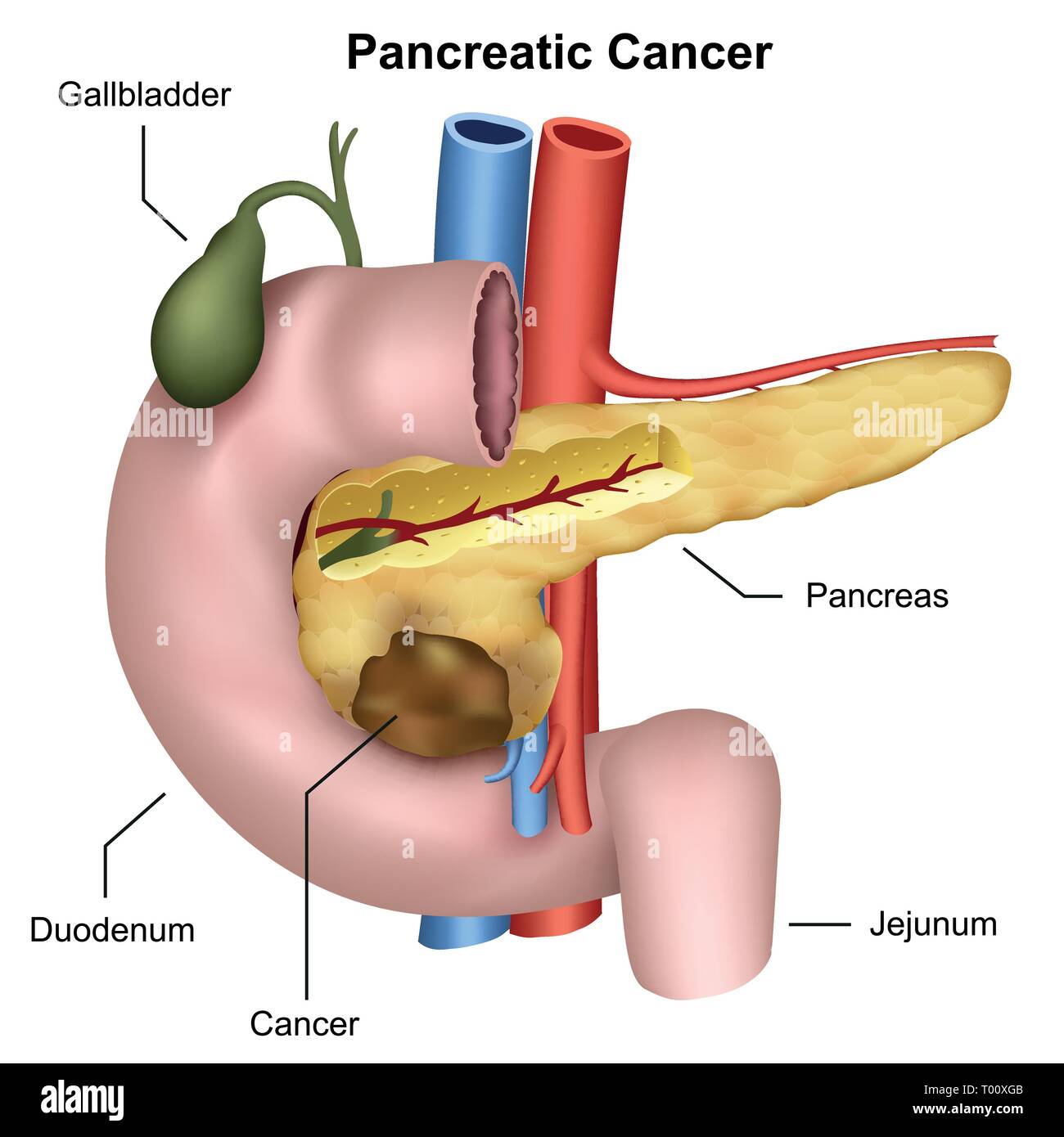 Vector illustration médicale cancer du pancréas Illustration de Vecteur