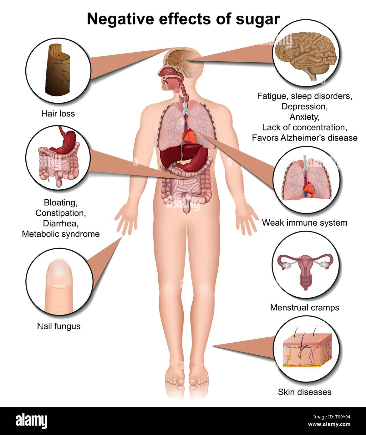 Effets secondaires de sucre sur le corps humain 3D medical vector illustration Illustration de Vecteur