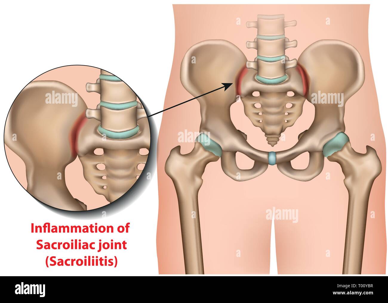 L'inflammation des articulations sacro-iliaque médicale 3d vector illustration sacro-iliite à la radiographie Illustration de Vecteur