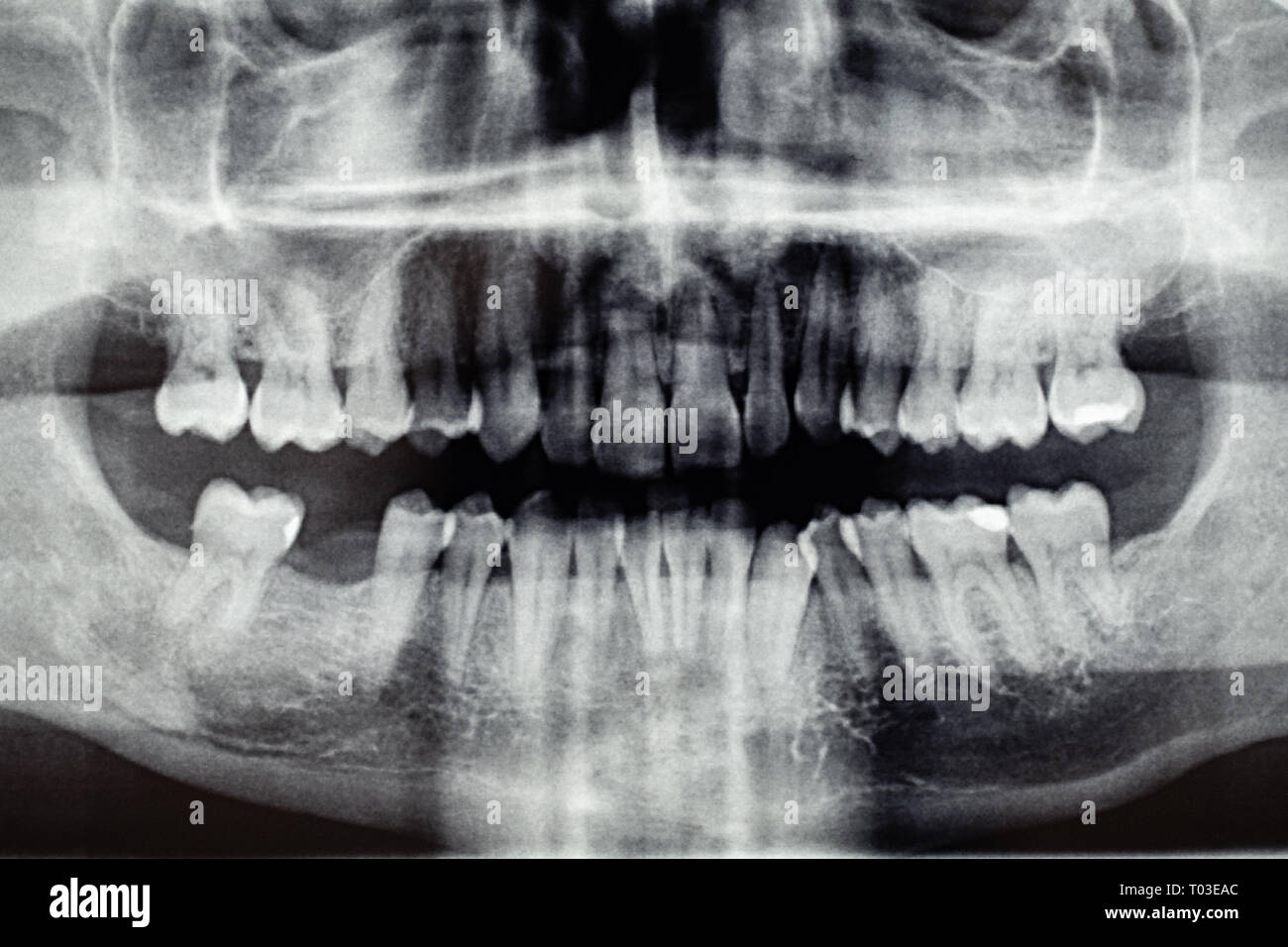 La radiographie dentaire panoramique, un trou de la dent retour Banque D'Images