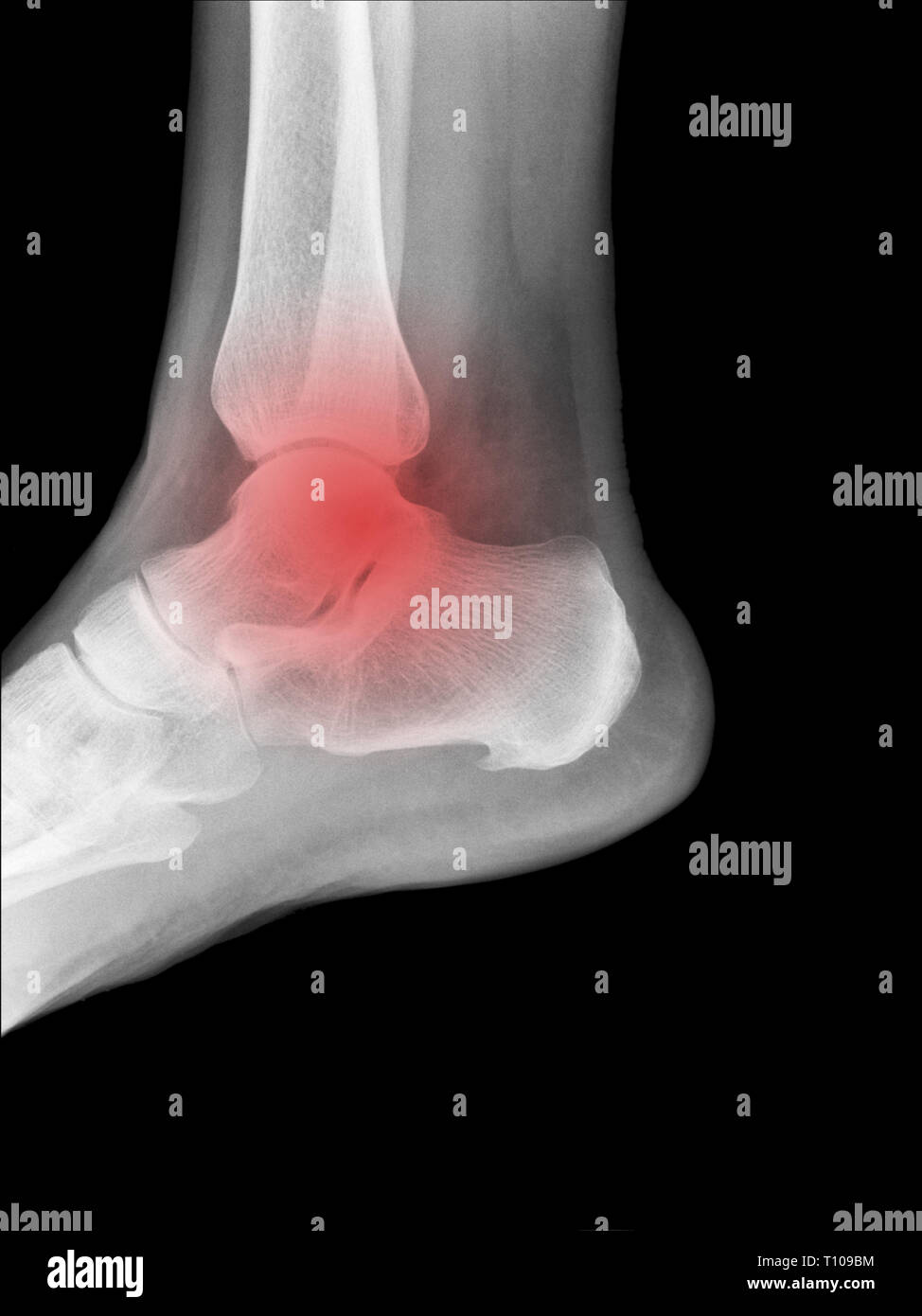 X-ray medical photo - pied humain avec symbole rouge de l'endroit douloureux Banque D'Images