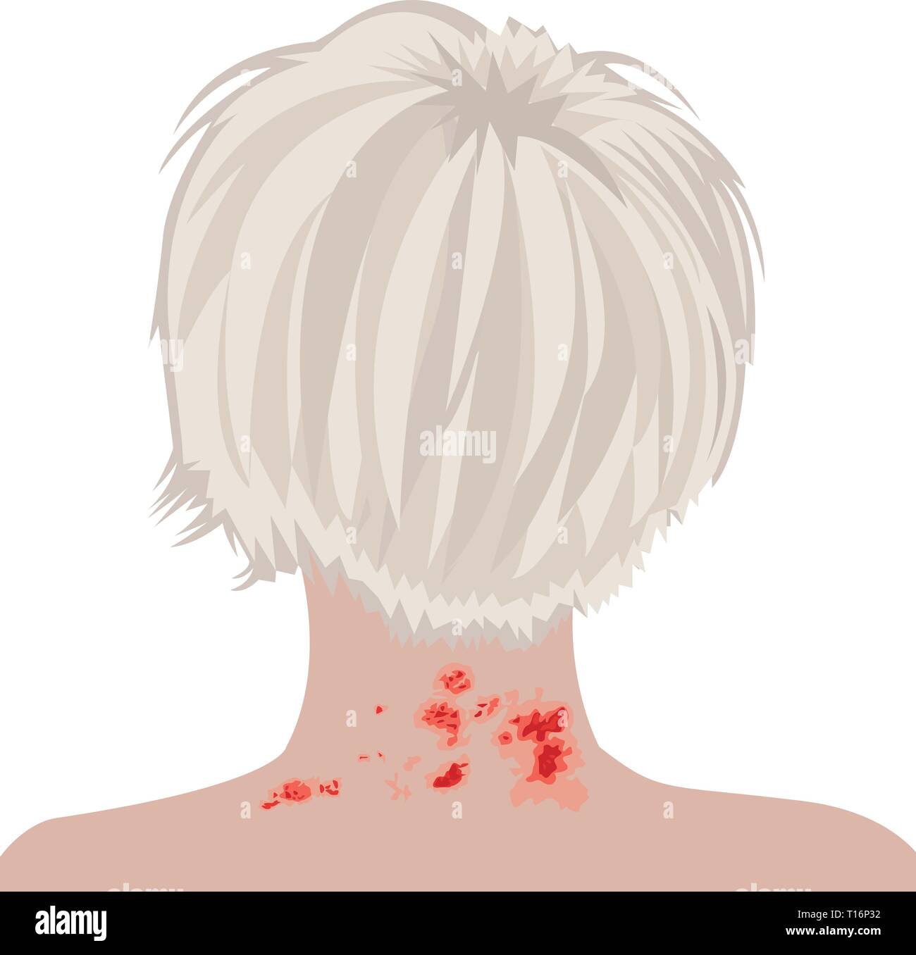 Les bardeaux sur l'épaule d'une femme d'illustration vectorielle de varicelle-zona. Illustration de Vecteur