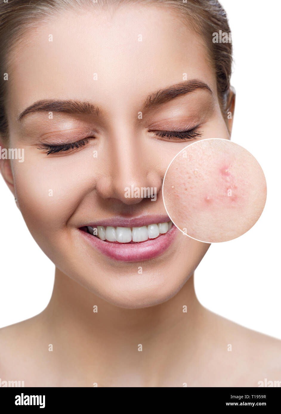 Jeune femme avec la peau acné zoom en cercle. Banque D'Images