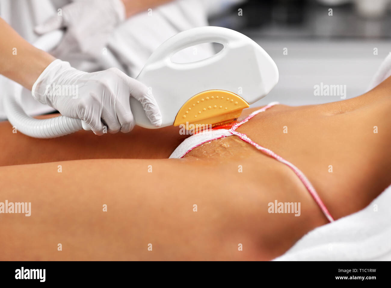 Photo de traitement au laser épilation Beauté donnant à la femme sur Bikini  Photo Stock - Alamy