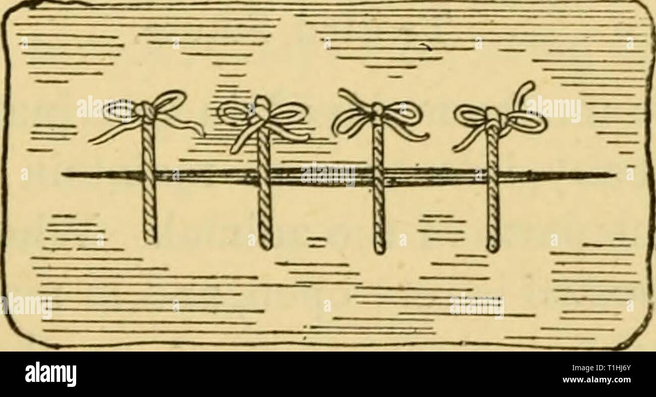Maladies et affections des maladies et troubles de l'alimentation du cheval : un traité sur la médecine et de la chirurgie équines diseasesdisorder00gres Année : 1886 Les illustrations ci-dessus montrent, d'abord, deux aiguilles à suture commun, et deuxièmement de Simpson et à l'aiguille. Suture interrompue, Banque D'Images