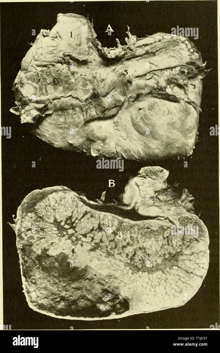 Les maladies de l'appareil génital Les maladies des organes génitaux des animaux domestiques diseasesofgenita00s Année : 1921 La tuberculose génitale 1X1 Fig. 215-Tuberculose du testicule. Sanglier. A, B, section médiane ; face externe du testicule montrant l'épididyme. / Cordon spermatique, ; 2, chef de l'épididyme ; 3, 4 ; masses tuberculeuses, tuber- culière cavité ; abcès 5, corps de l'épididyme : 6, section à travers l'épididyme révélant des masses tuberculeuses. 47 Banque D'Images