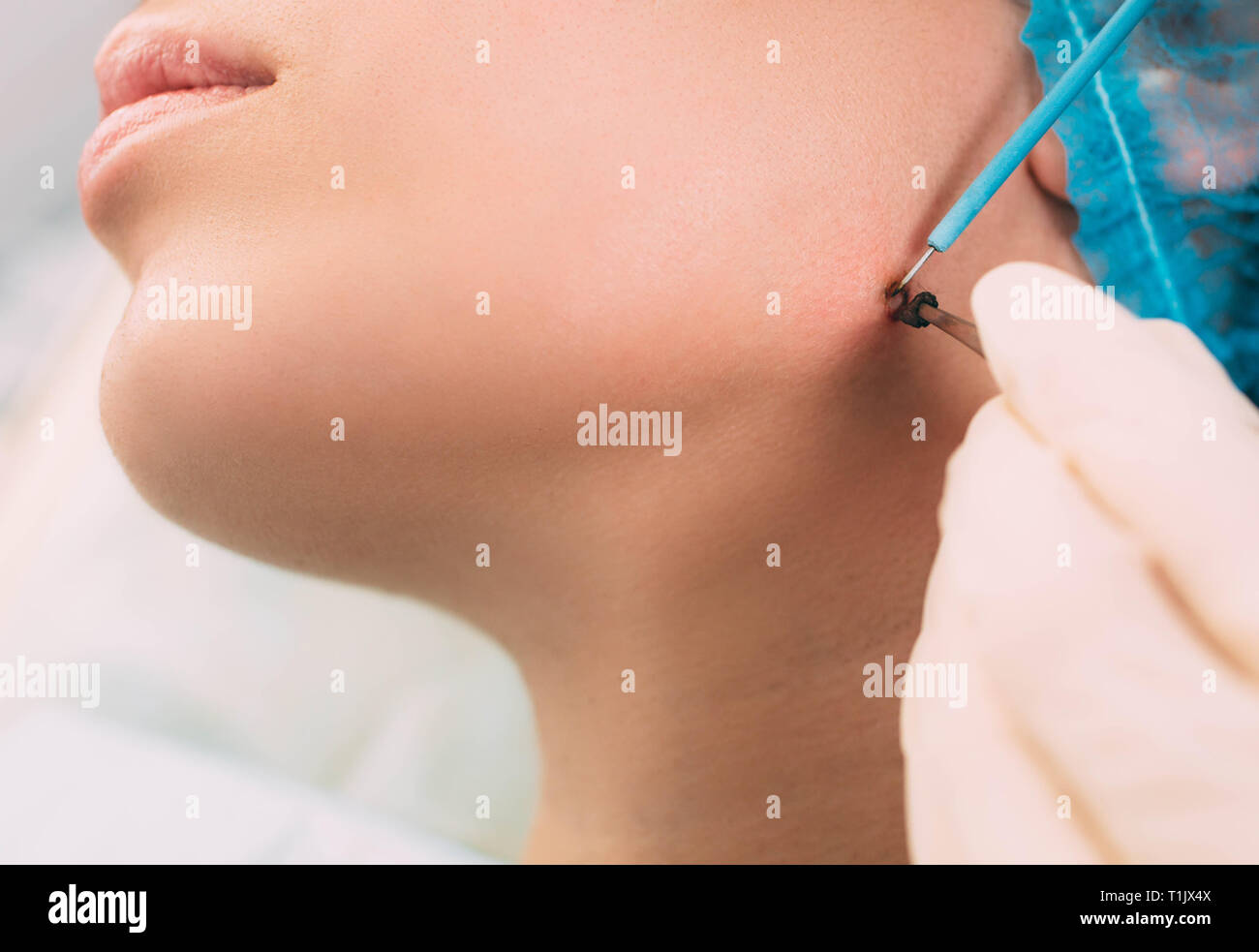 Patient qui mole dépose avec l'électrocautérisation et pinces chirurgicales sur son visage. L'électrocoagulation d'onde radio méthode remove Banque D'Images