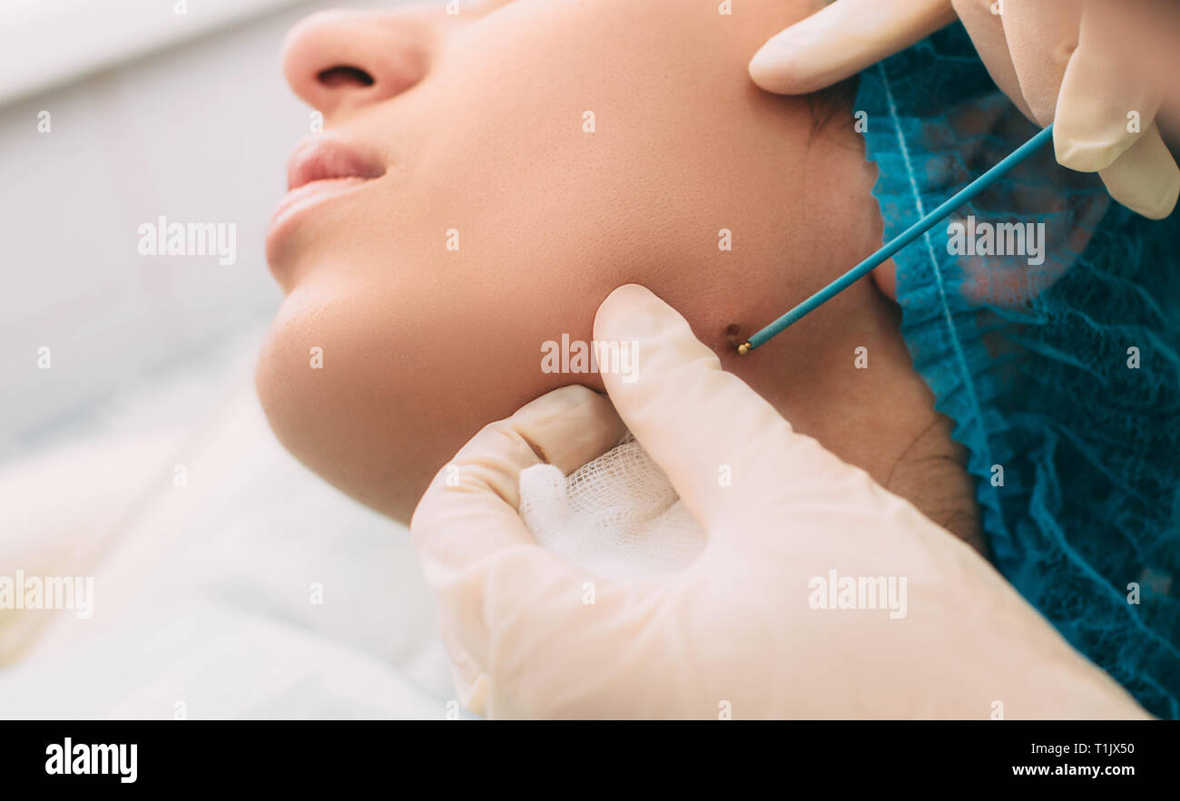 Patient qui mole dépose avec l'électrocautérisation et pinces chirurgicales sur son visage. L'électrocoagulation d'onde radio méthode remove Banque D'Images