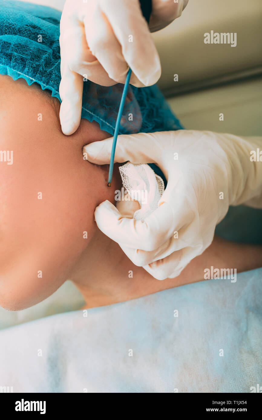 Patient qui mole dépose avec l'électrocautérisation et pinces chirurgicales sur son visage. L'électrocoagulation d'onde radio méthode remove Banque D'Images