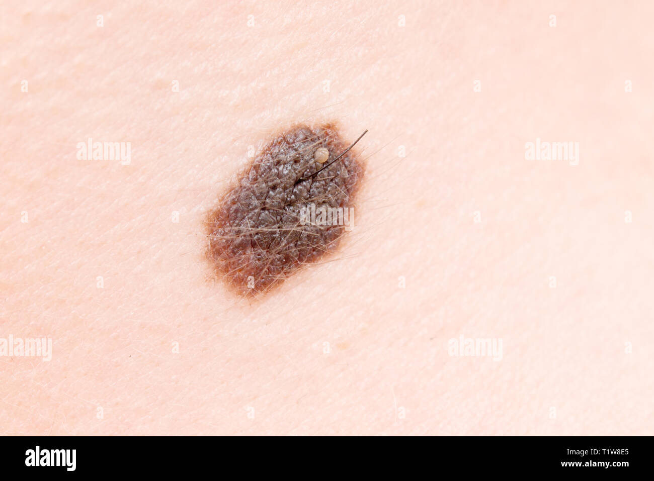 Gros Grain De Beauté Sur Une Peau Banque Dimages Photo