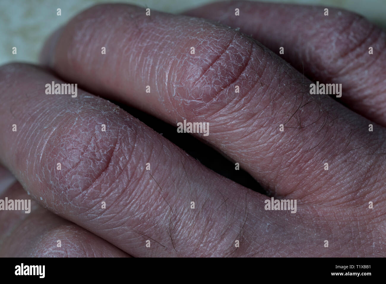 FISSURES DES DOIGTS : petites crevasses douloureuses sur et entre les doigts  – Dermatologue en téléconsultation, crevasse doigt