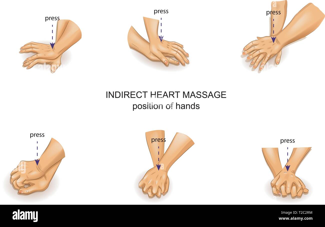 Vector illustration de la position du médecin dans les mains de massage cardiaque indirect Illustration de Vecteur