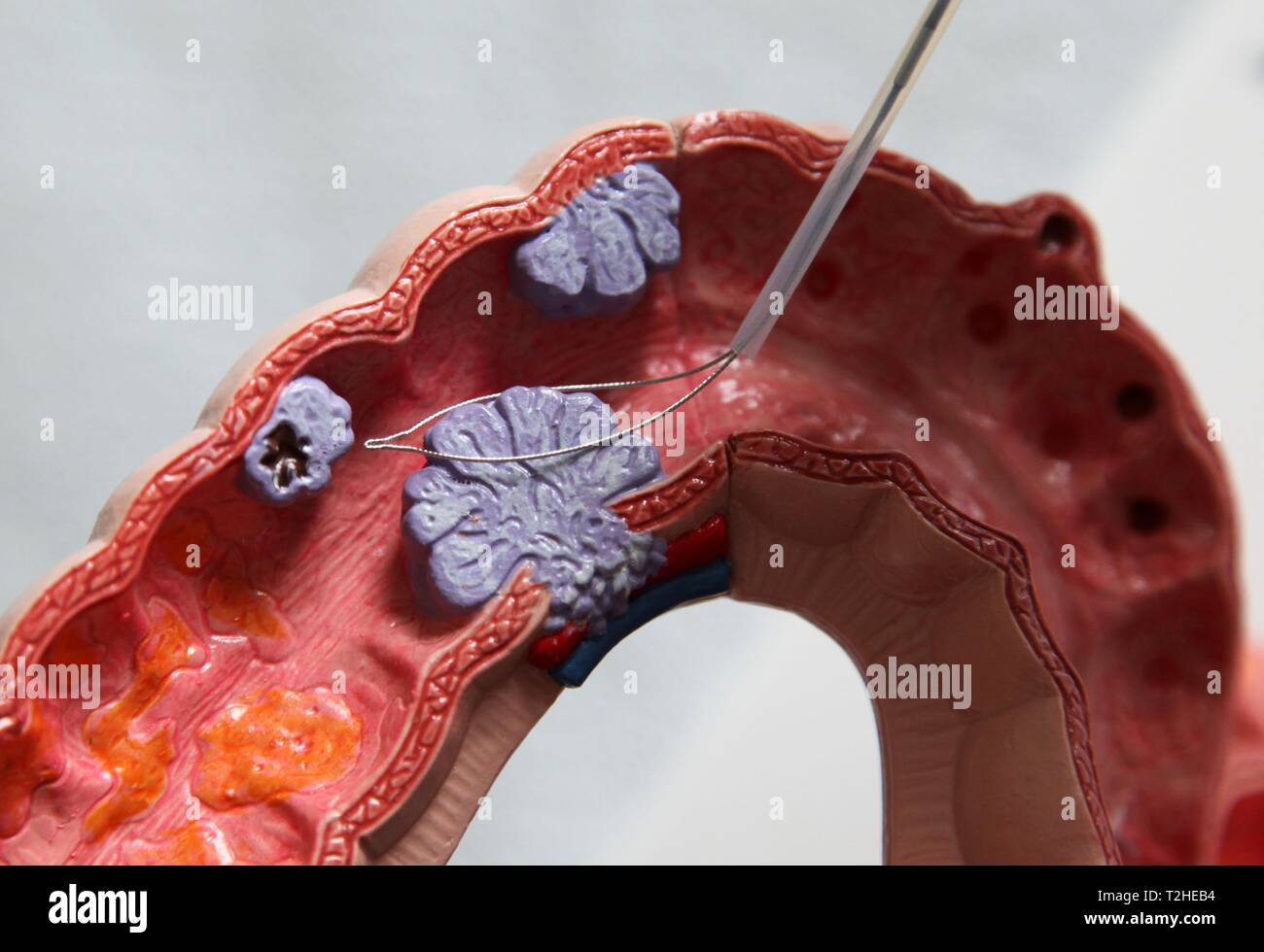 La coloscopie, l'élimination des excroissances dans l'intestin humain sur un modèle médical, Allemagne Banque D'Images