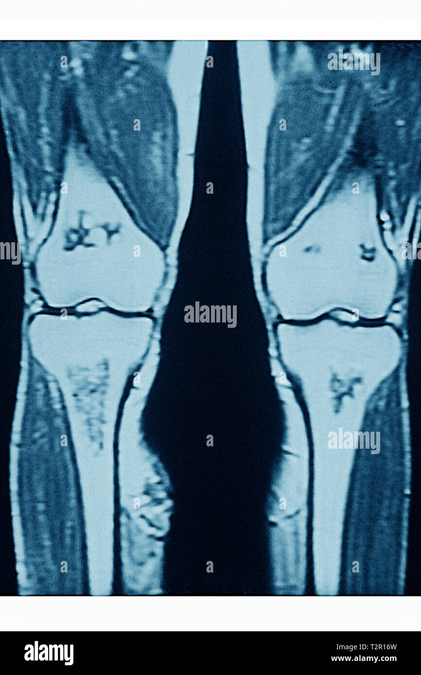 Arthrite Banque D'Images