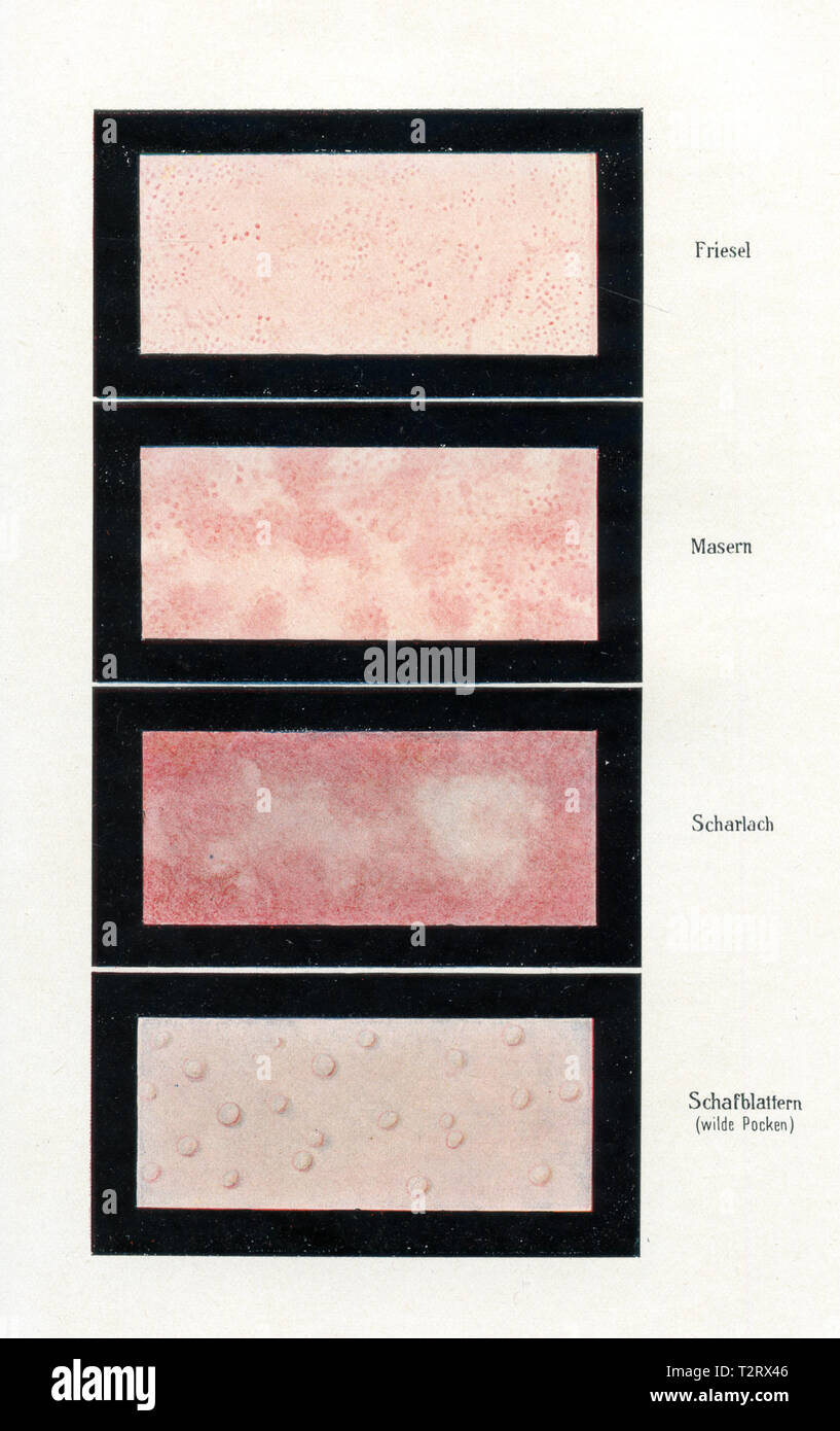 L'apparence de la peau (Friesel la fièvre associée à une éruption cutanée), la rougeole, la scarlatine, la variole ovine feuilles (Wild, à la varicelle), 1900 Banque D'Images