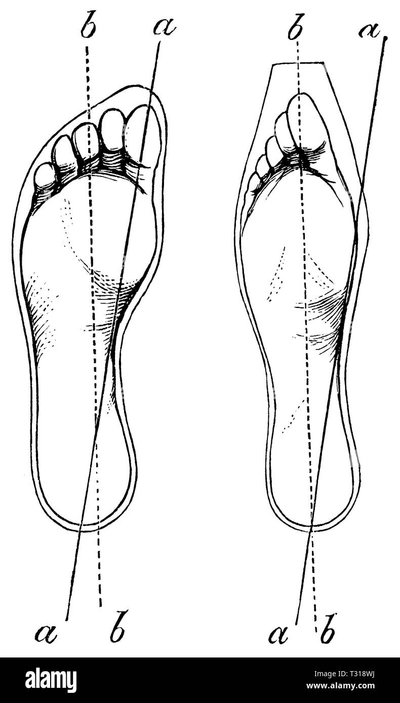 Homme : - pied pied normal (à gauche), une difformité du pied (à droite), anonym Banque D'Images