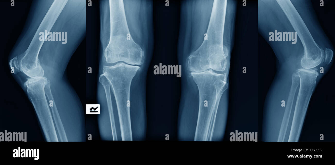 X-ray image de l'arthrose du genou dans ton bleu Photo Stock - Alamy