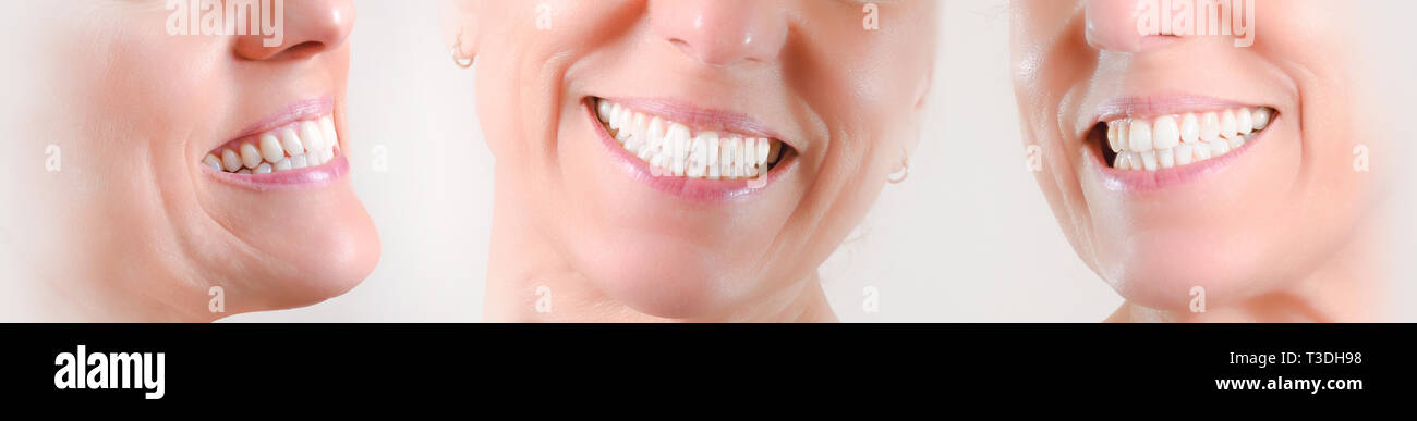Ensemble de trois vues d'une dentition blanche naturelle d'une femme de race blanche avec des boucles d'or Banque D'Images