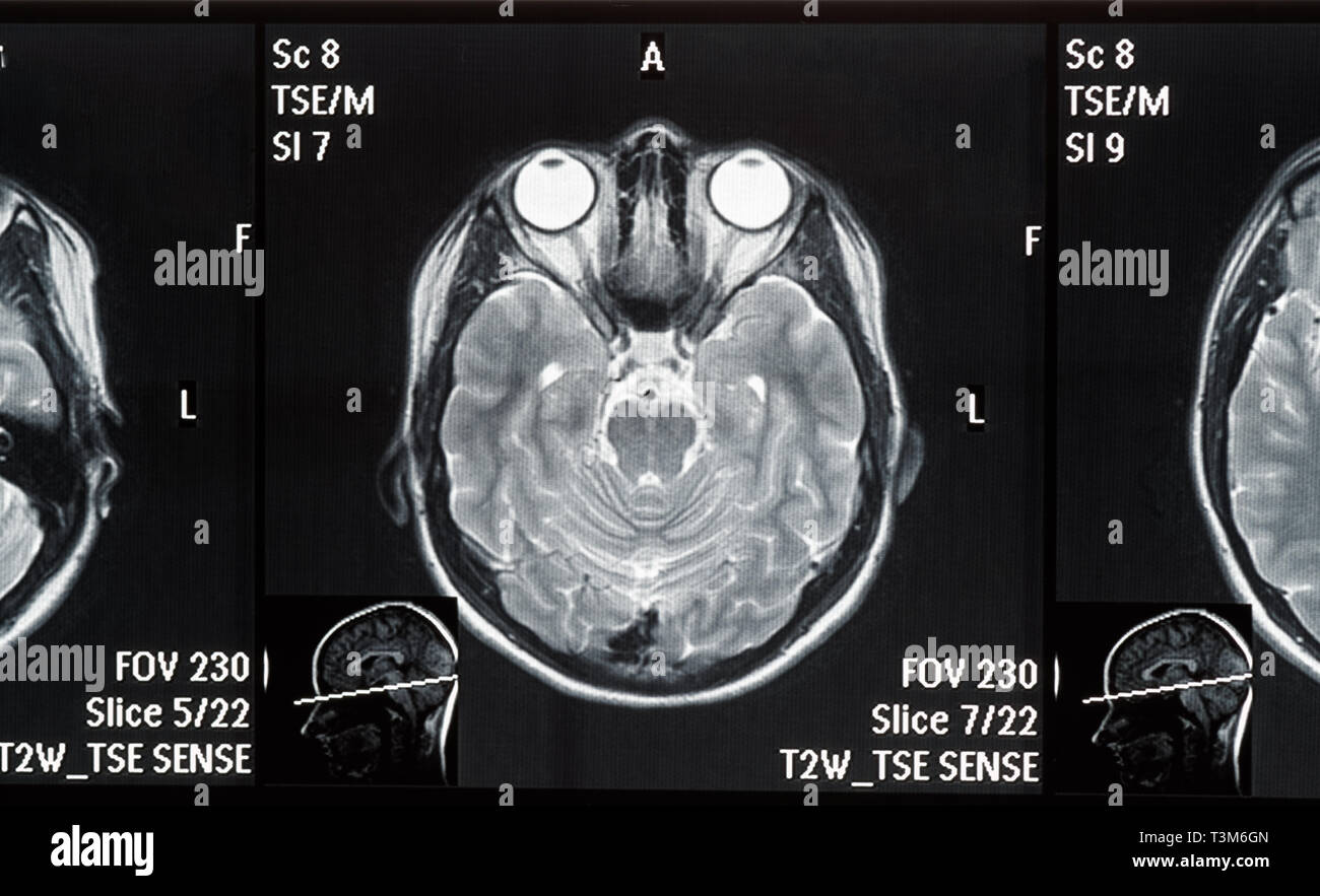 Faites glisser l'IRM cérébrale réelle d'une jeune femme. Clinique du patient et les noms du supprimé Banque D'Images