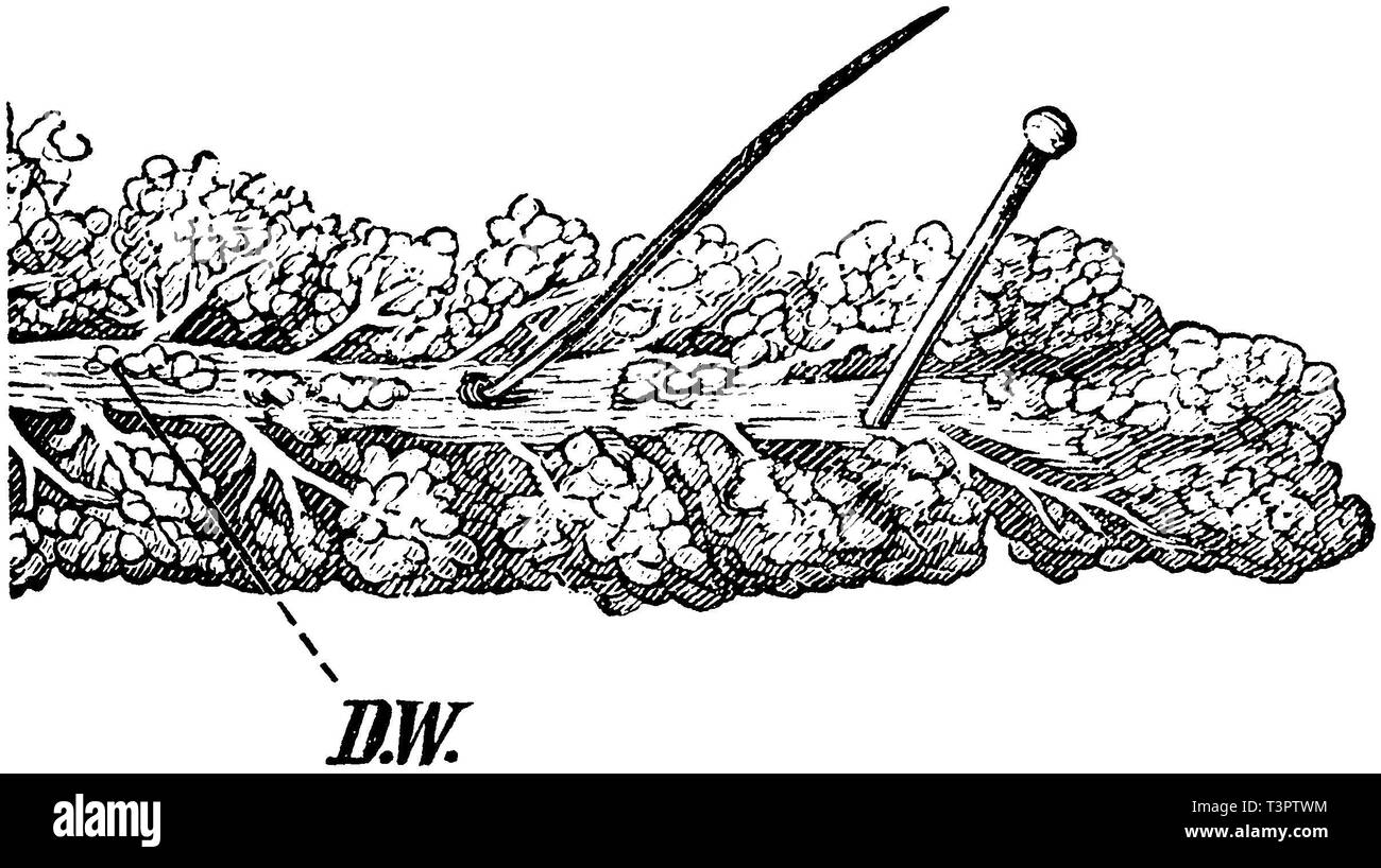 Les droits de l' : pancréas, D.W. Pignon d'Wirsungian séparés, d'une verrue-comme bosse, anonym 1887 Banque D'Images